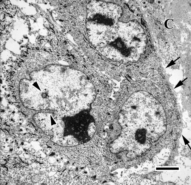 Ingluvial Squamous Cell Carcinoma in a Game Chicken