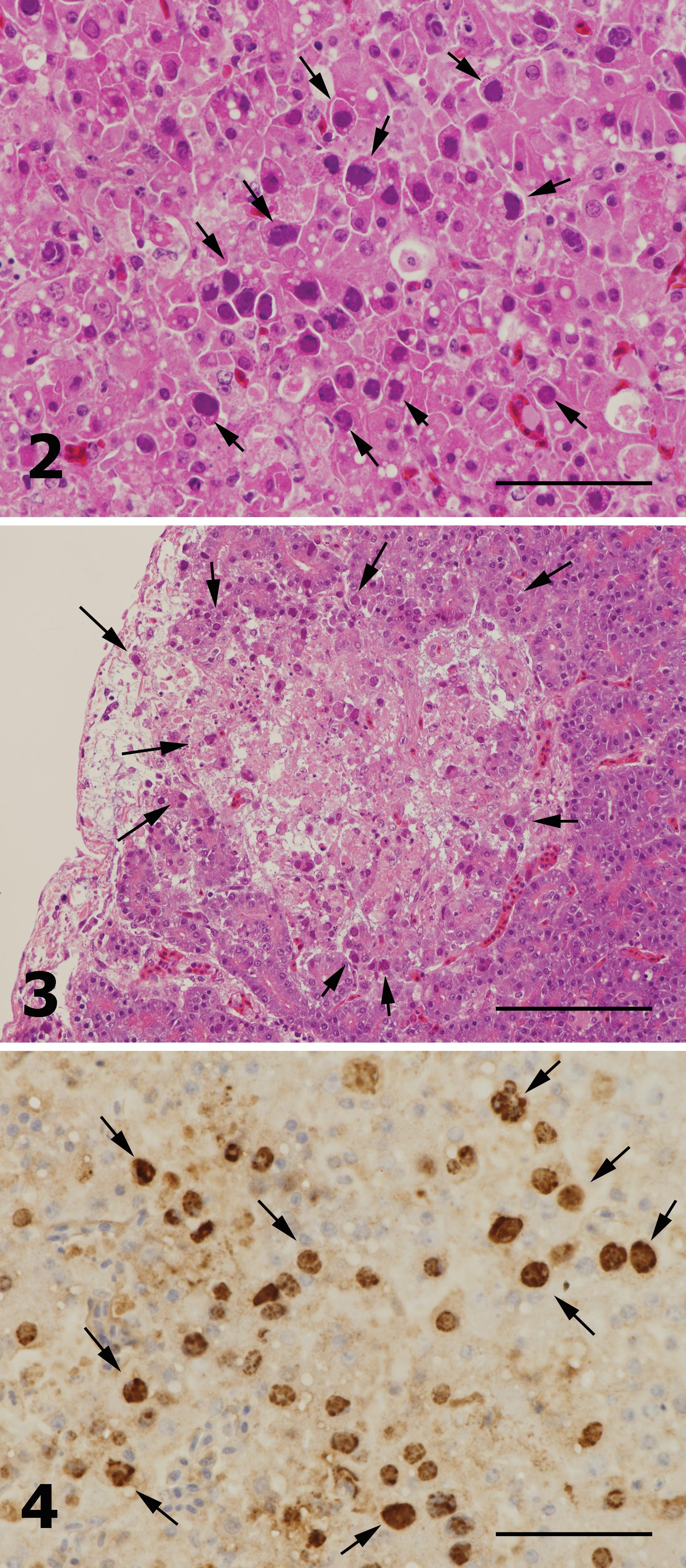 Inclusion Body Hepatitis Caused By Fowl Adenovirus In Broiler Chickens ...