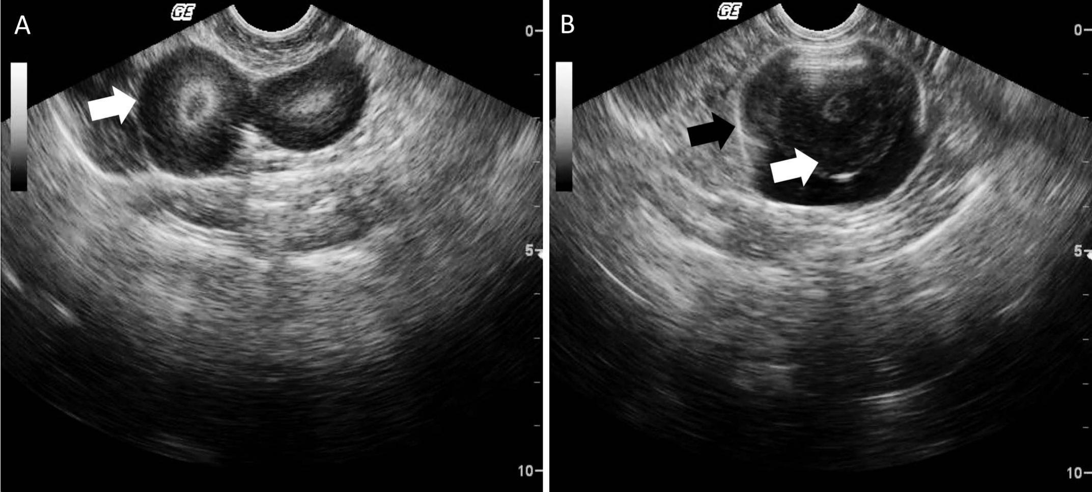 Diagnostic Accuracy of Ultrasonography to Detect False Layers in a ...