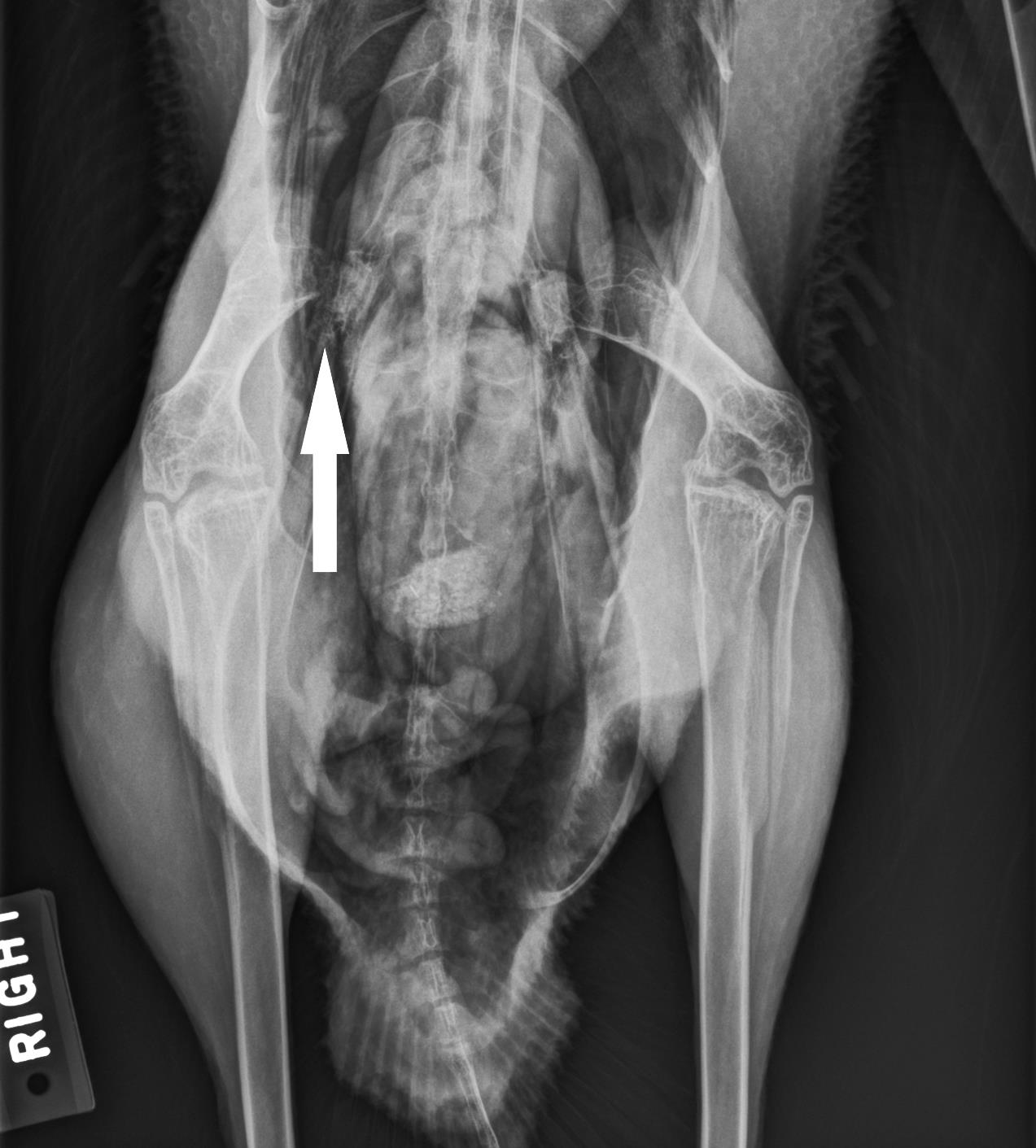 Successful Management Of Simple Fractures Of The Femoral Neck With 