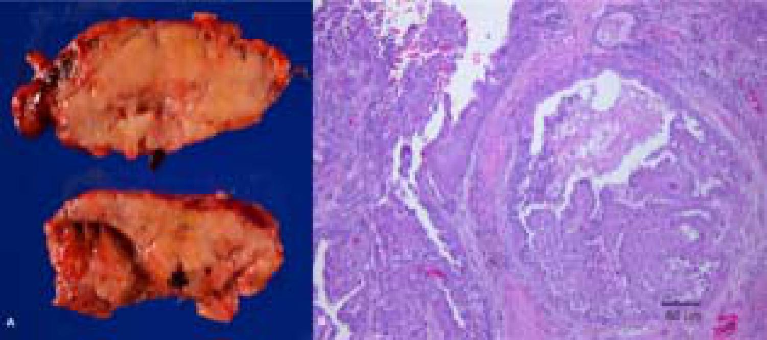 Absolute Erythrocytosis in a Sunda Wrinkled Hornbill (Aceros corrugatus)