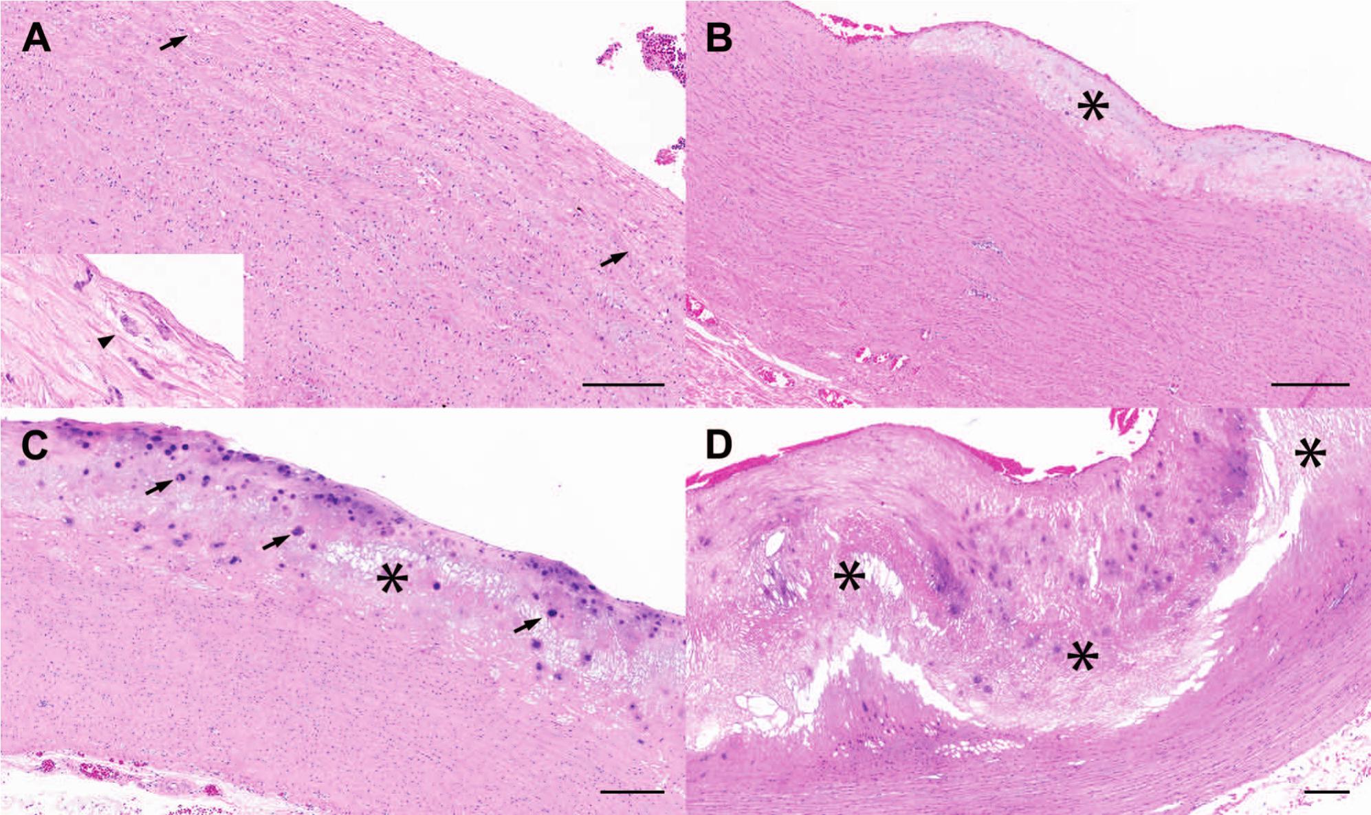 A Definition of Advanced Types of Atherosclerotic Lesions and a  Histological Classification of Atherosclerosis