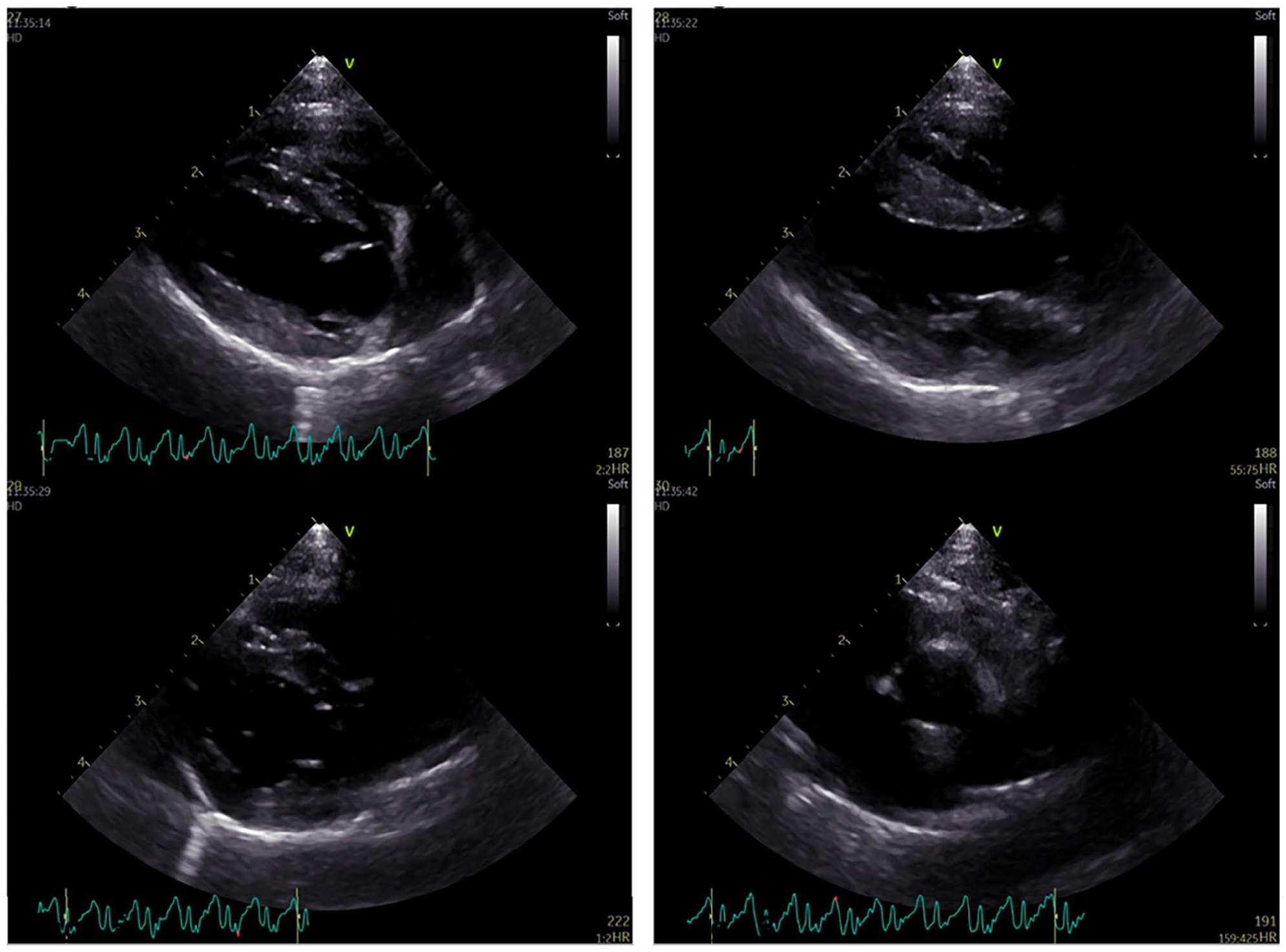 Possible sinoatrial node dysfunction in a 6-month-old domestic ...