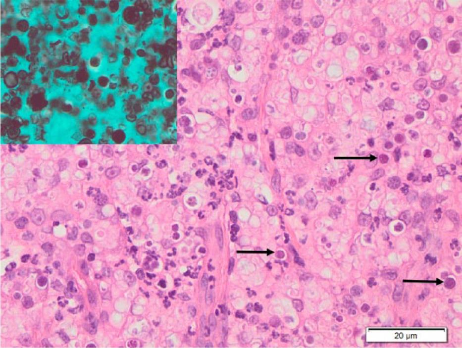 Successful treatment of multifocal pedal Prototheca wickerhamii ...