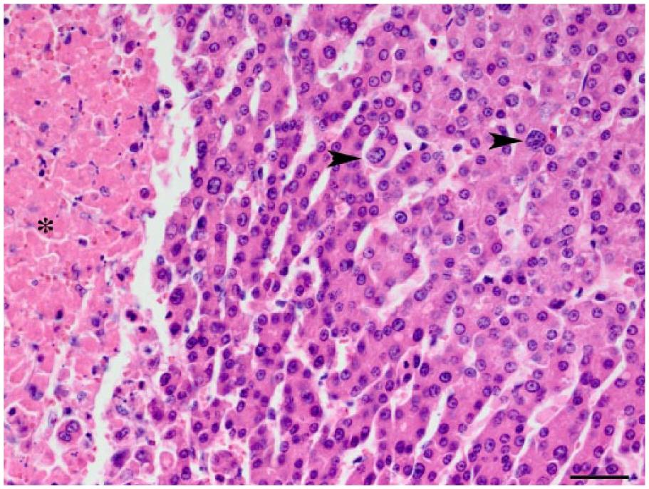 Caecocolic intussusception associated with a caecal polyp and ...