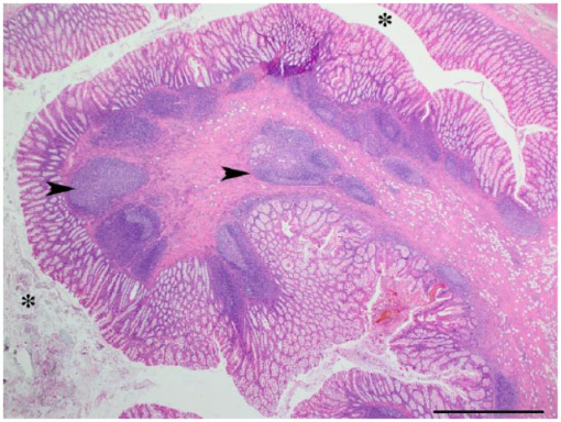 Caecocolic intussusception associated with a caecal polyp and ...