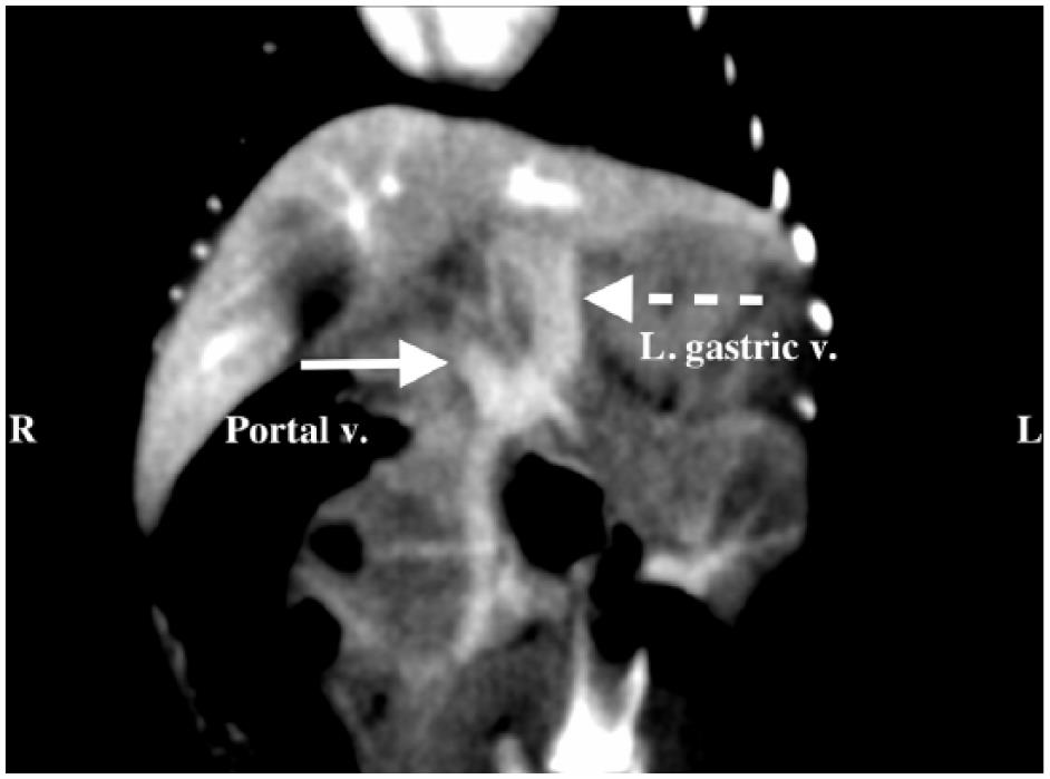 Caroli Types Caroli’s-type ductal plate malformation and a portosystemic shunt in a ...