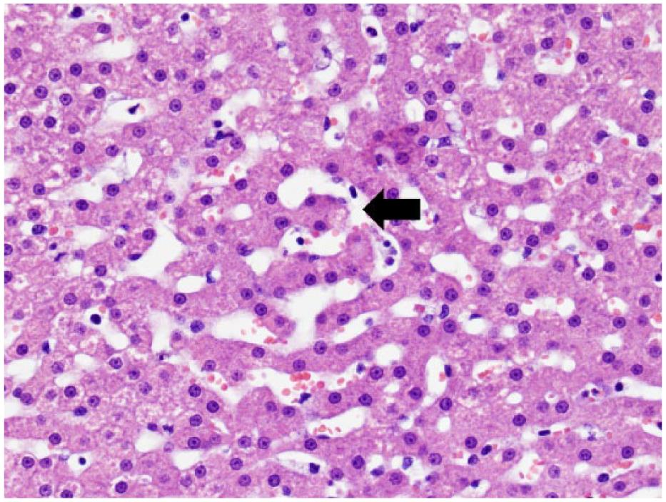 Caroli Types Caroli’s-type ductal plate malformation and a portosystemic shunt in a ...
