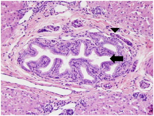 Caroli’s-type ductal plate malformation and a portosystemic shunt in a ...