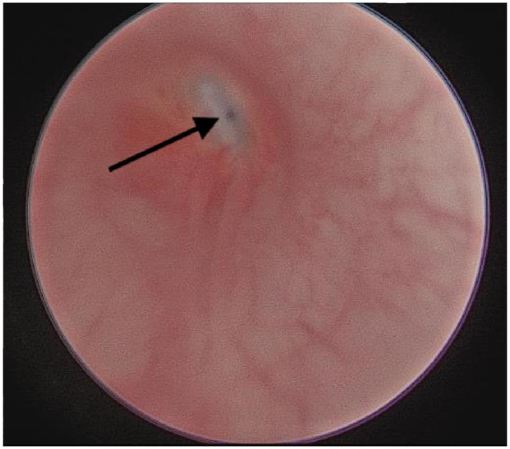 Fluoroscopy-guided balloon dilation of a proximal urethral ...