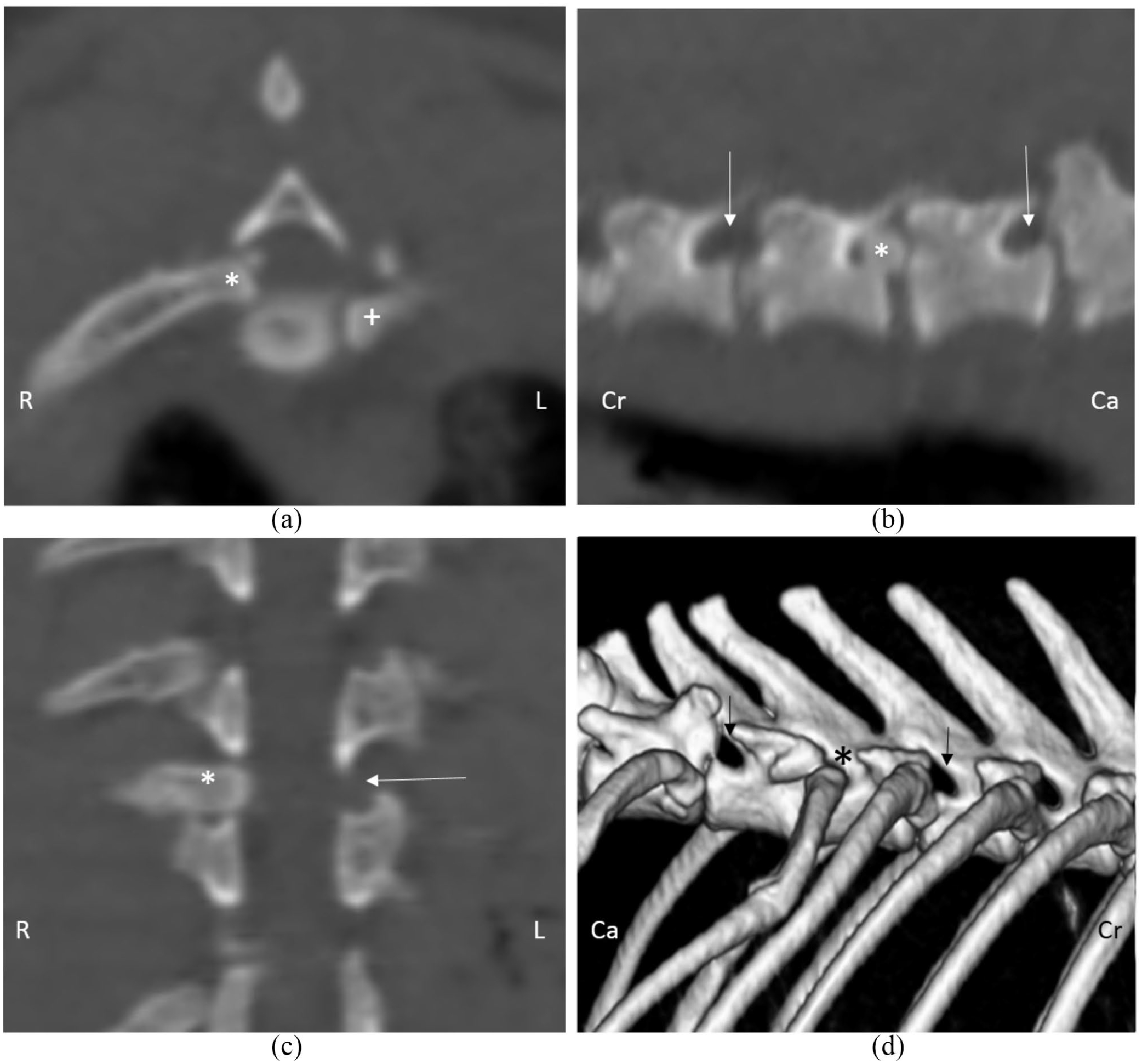 Subluxation Of Rib Traumatic rib head subluxation through the intervertebral foramen ...
