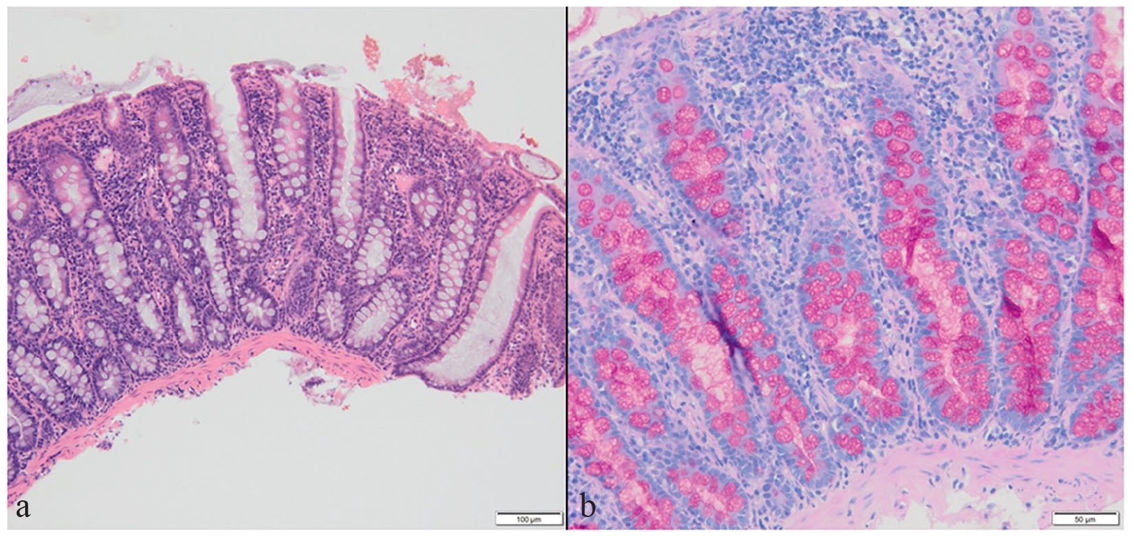 Repeat histopathology and culture of colonic biopsy specimens after ...