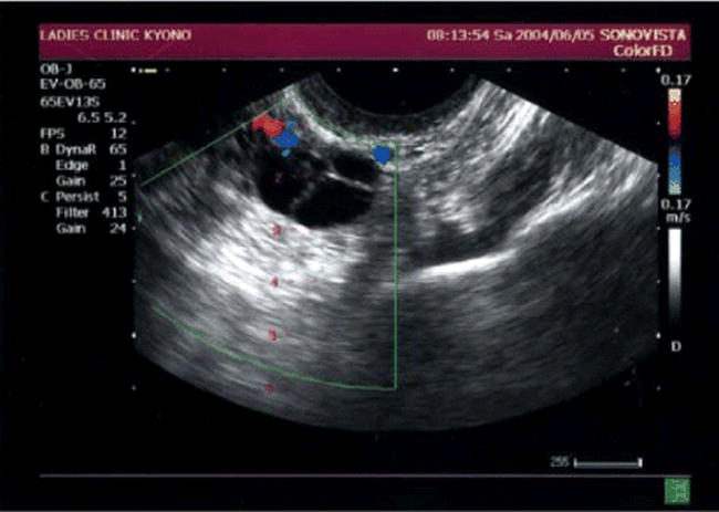 Evidence Based Oocyte Aspiration And Embryo Transfer - 