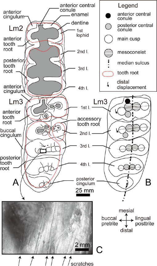 Prevalence of medial depression of the mandibu- lar ramus (MDMR) in the