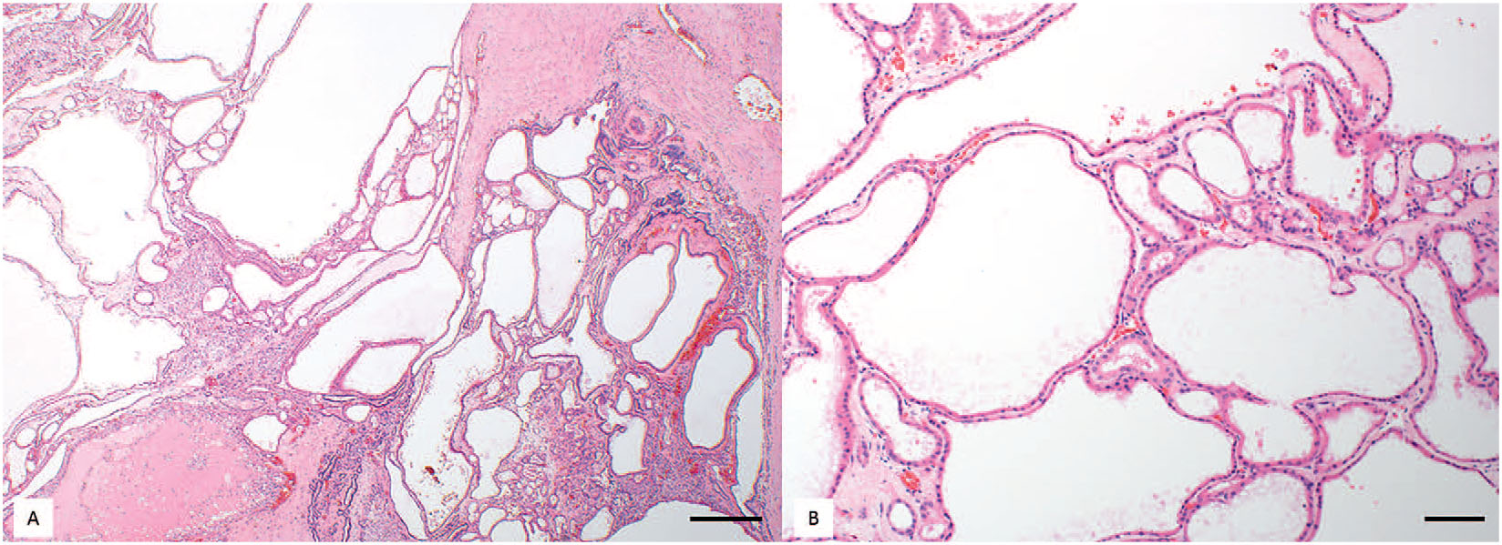 Bilateral Polycystic Kidneys and Focal Renal Cystadenoma in a Pygmy ...