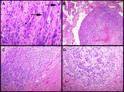 Metastatic Anaplastic Sarcoma In A Wild Lace Monitor (varanus Varius)