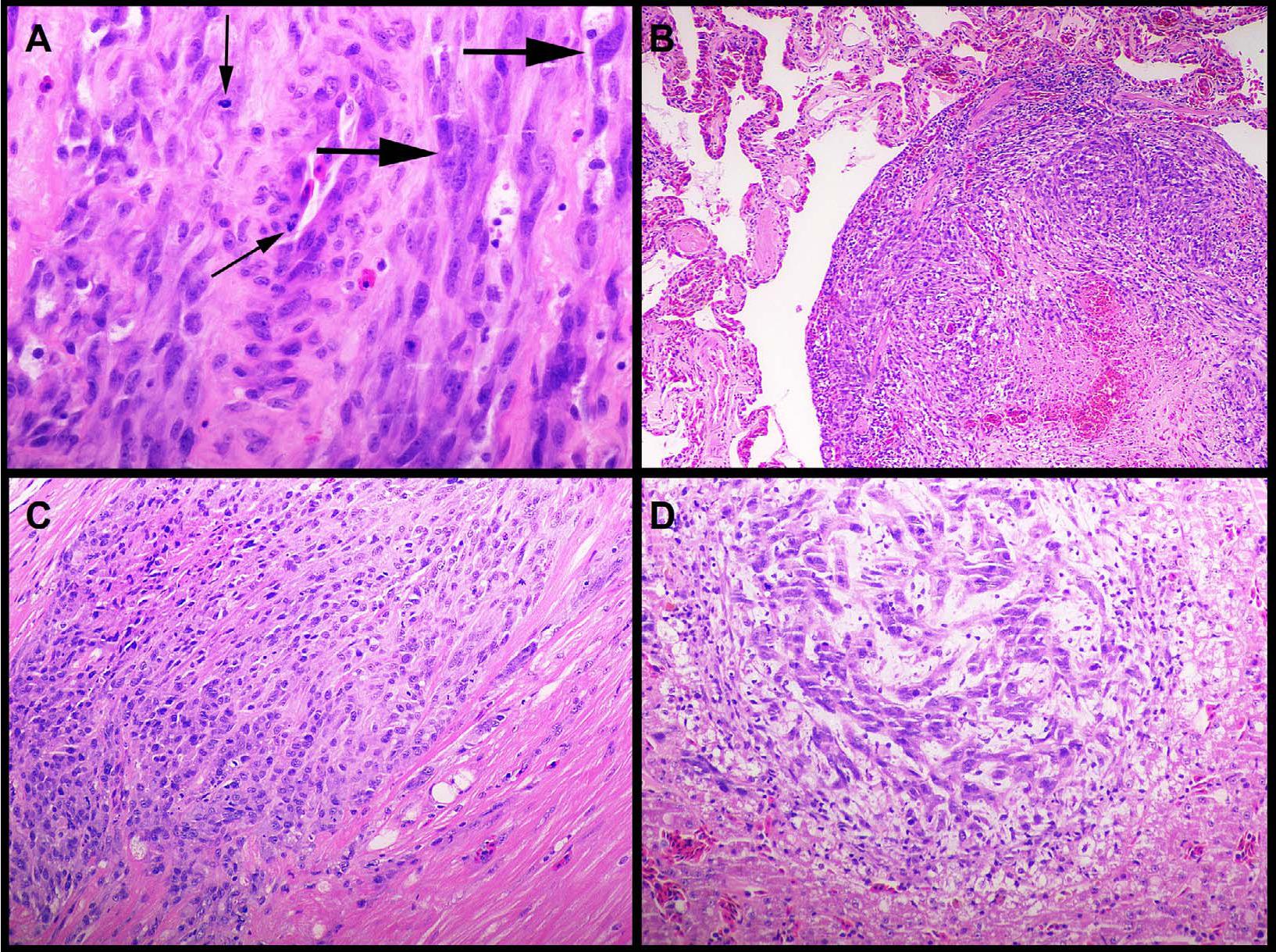 Metastatic Anaplastic Sarcoma in a Wild Lace Monitor (Varanus varius)