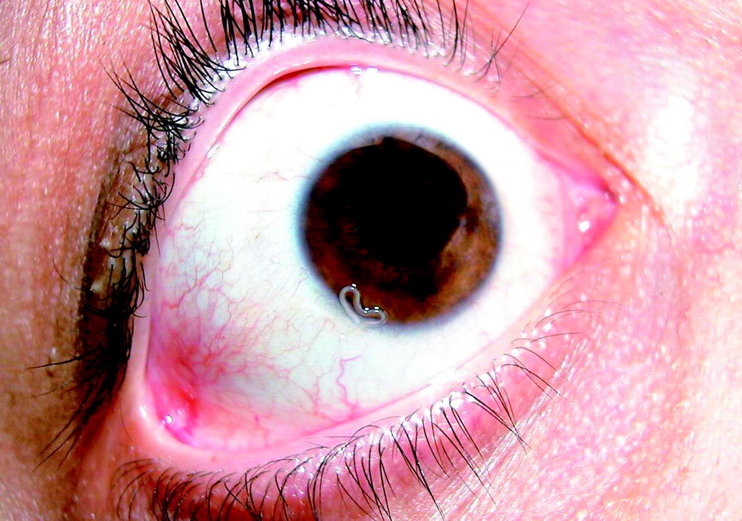 Human Thelaziosis—A Neglected Parasitic Disease of the Eye