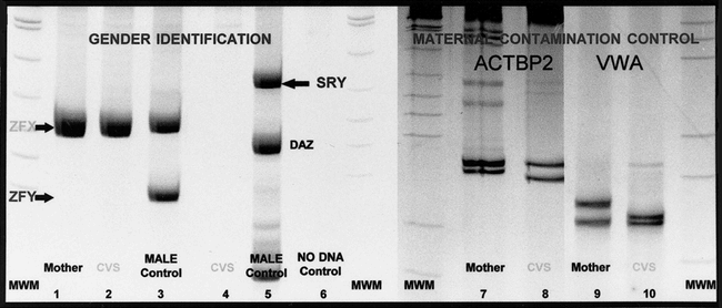 CHORIONIC VILLUS SAMPLING FOR SEX DETERMINATION IN A WESTERN LOWLAND ...