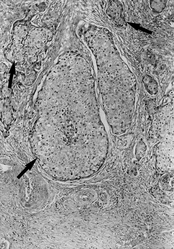 GONGYLONEMA PULCHRUM INFECTION AND ESOPHAGEAL SQUAMOUS CELL CARCINOMA ...