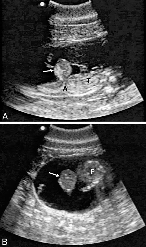 FETAL OMPHALOCELE IN A COMMON BOTTLENOSE DOLPHIN (TURSIOPS TRUNCATUS)