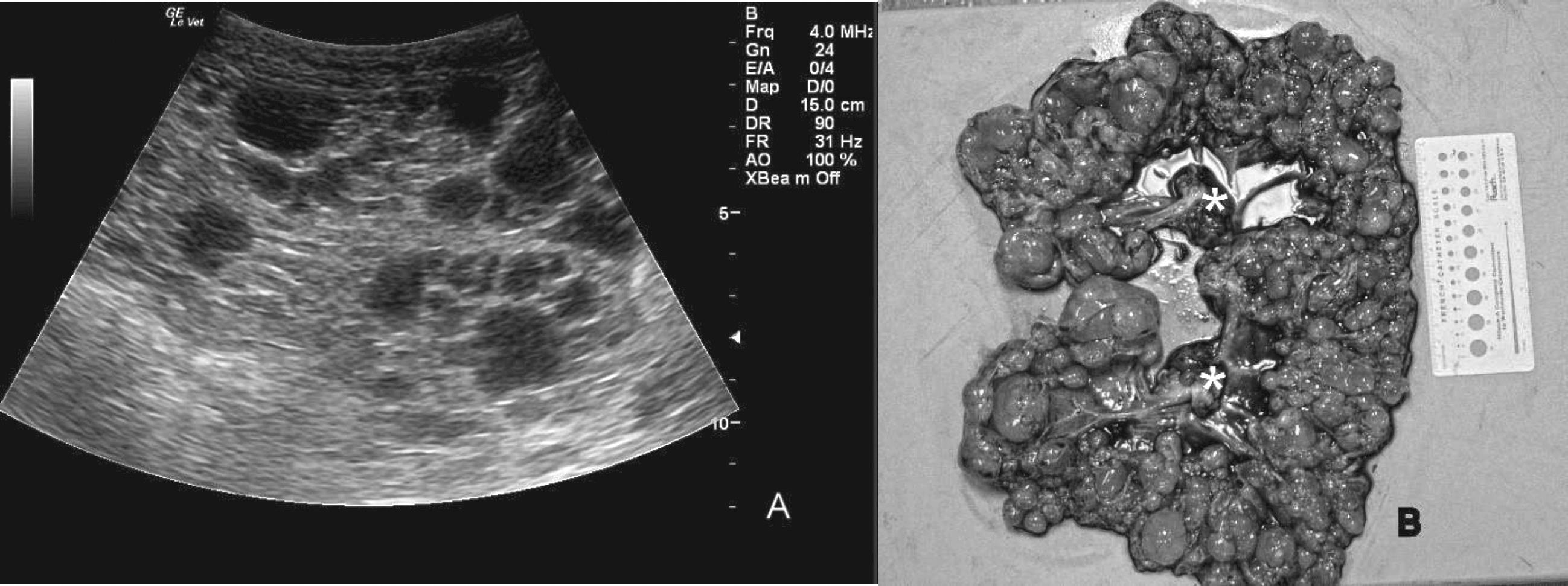 Endometrial Hyperplasia Ultrasound