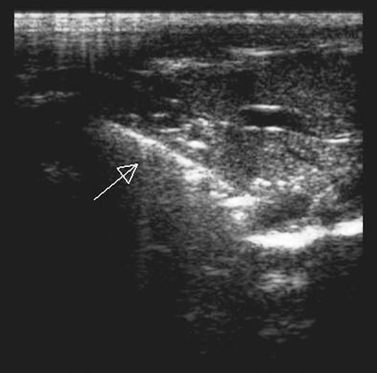 PRELIMINARY EVALUATION OF SPIROTOME® DEVICE FOR LIVER BIOPSY IN GREEN ...