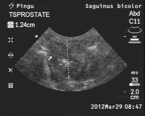 DIAGNOSIS AND MANAGEMENT OF BENIGN PROSTATIC HYPERPLASIA IN A PIED ...