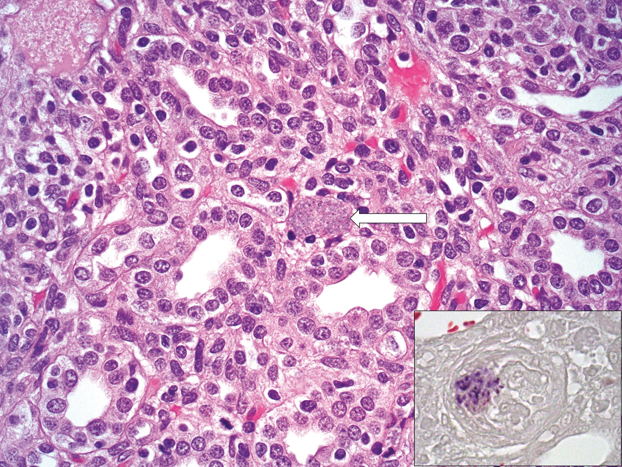 SYSTEMIC ENCEPHALITOZOONOSIS DUE TO ENCEPHALITOZOON CUNICULI STRAIN IV ...