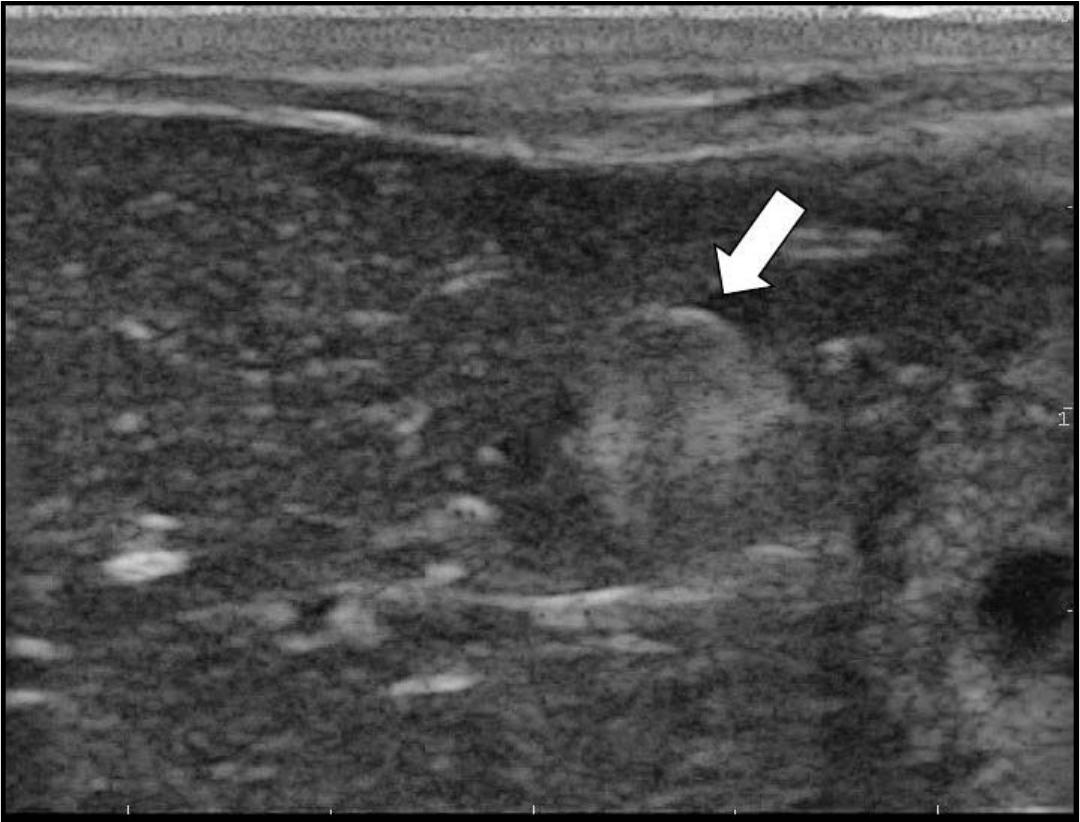 ULTRASOUND-GUIDED PERCUTANEOUS TREATMENT OF HEPATIC HYDATIDOSIS IN TWO ...